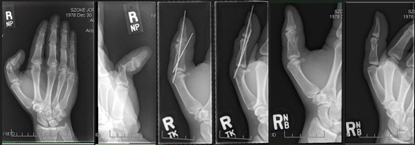 These x-rays provided by Szoke show his thumb through the various stages over the last two months. Pre Surgery Aug 10th - Post Surgery Aug 13th - Post Pin Removal Sept 2nd 2014.